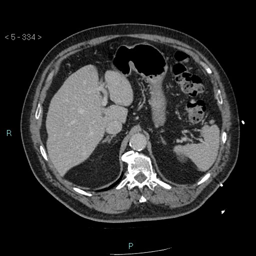 Aortic intramural hematoma (Radiopaedia 48463-53380 C 150).jpg