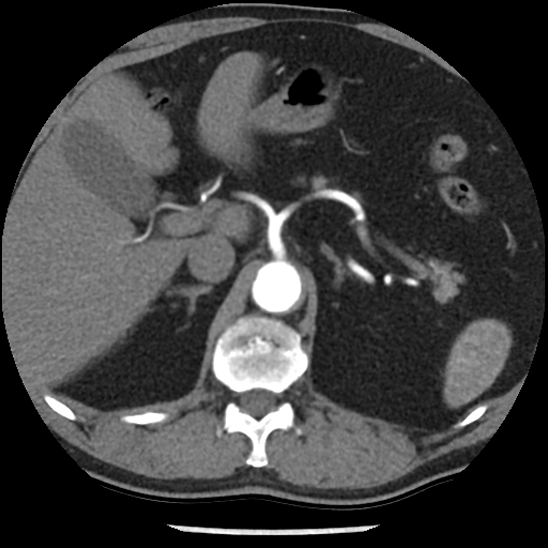 Aortic intramural hematoma (type B) (Radiopaedia 79323-92387 B 58).jpg