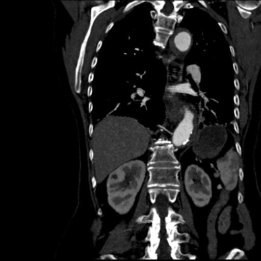 Aortic intramural hematoma from penetrating atherosclerotic ulcer (Radiopaedia 31137-31836 C 44).jpg