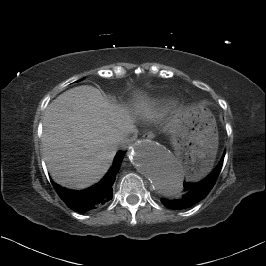 File:Aortic intramural hematoma with dissection and intramural blood pool (Radiopaedia 77373-89491 Axial non-contrast 80).jpg