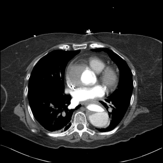 Aortic intramural hematoma with dissection and intramural blood pool (Radiopaedia 77373-89491 B 69).jpg