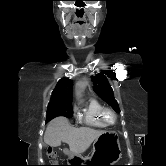 Aortic intramural hematoma with dissection and intramural blood pool (Radiopaedia 77373-89491 C 12).jpg