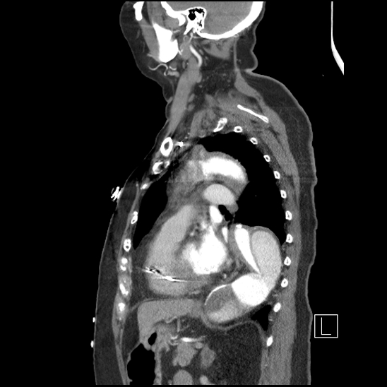 File:Aortic intramural hematoma with dissection and intramural blood pool (Radiopaedia 77373-89491 D 55).jpg