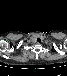 Aortic valve endocarditis (Radiopaedia 87209-103485 Axial non-contrast 10).jpg