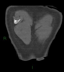 Aortic valve endocarditis (Radiopaedia 87209-103485 D 2).jpg
