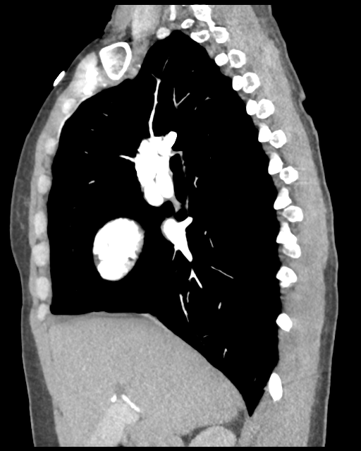Aortic valve non-coronary cusp thrombus (Radiopaedia 55661-62189 D 33).png