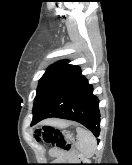 Aortic valve non-coronary cusp thrombus (Radiopaedia 55661-62189 D 8).png