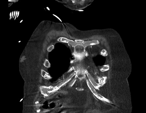 Aortoesophageal fistula with endovascular repair (Radiopaedia 73781-84592 Coronal C+ CTPA 4).jpg