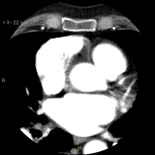 Aortoiliac occlusive disease (Radiopaedia 16828-16548 A 22).jpg