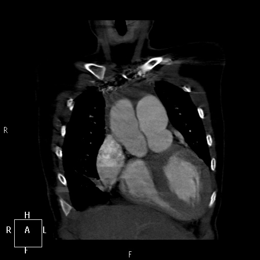 File:Aortopulmonary septal defect (Radiopaedia 41990-45013 Coronal C+ CTPA 10).jpg