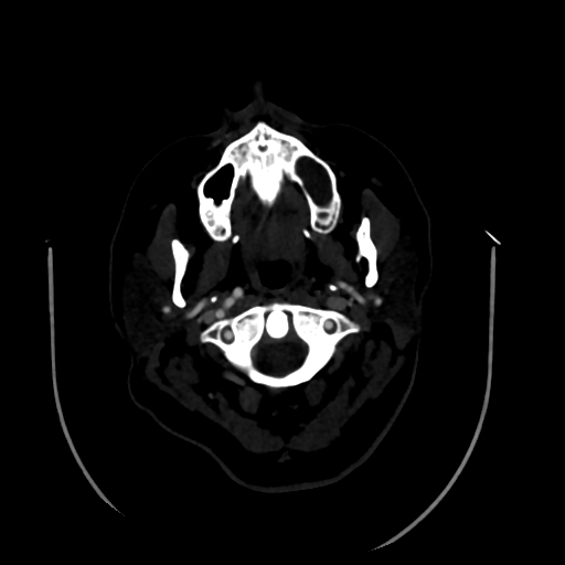 Aplasia of the internal carotid artery (Radiopaedia 61082-68960 A 1).jpg