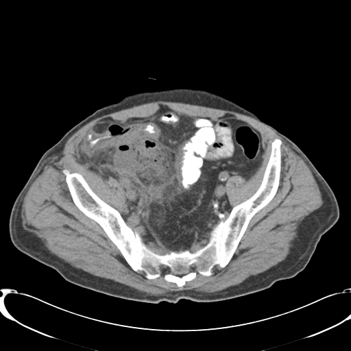 File:Appendiceal abscesses (Radiopaedia 50999-56542 Axial non-contrast 65).png