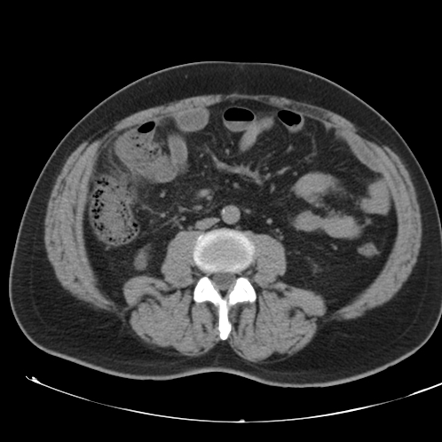 Appendicitis and giant appendicolith (Radiopaedia 80251-93588 Axial non-contrast 31).jpg