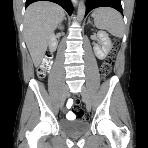 File:Appendicitis complicated by post-operative collection (Radiopaedia 35595-37113 B 32).jpg