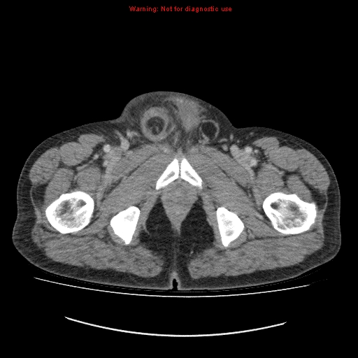 File:Appendicitis mass in inguinal hernia (Radiopaedia 26858-27029 A 34).jpg