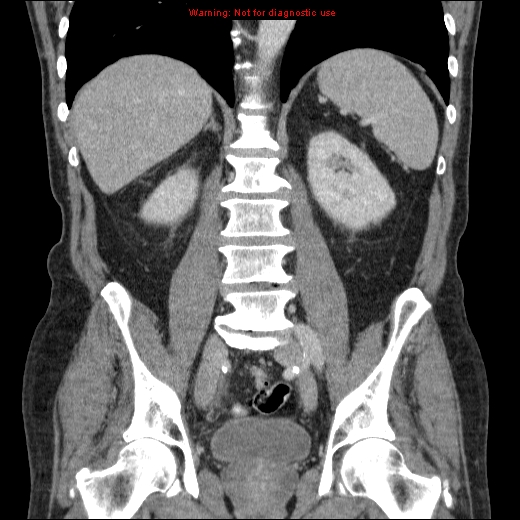 File:Appendicitis mass in inguinal hernia (Radiopaedia 26858-27029 B 49).jpg