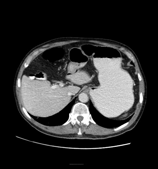 Appendicitis with localized perforation and abscess formation (Radiopaedia 49035-54130 A 24).jpg