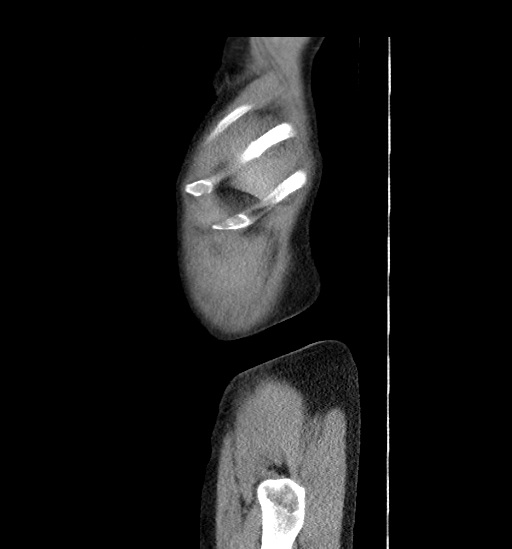 File:Appendicitis with localized perforation and abscess formation (Radiopaedia 49035-54130 C 3).jpg