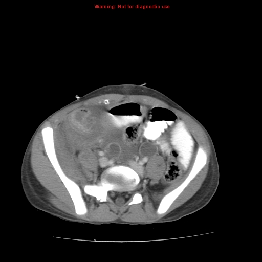 Appendicitis with phlegmon (Radiopaedia 9358-10046 A 51).jpg