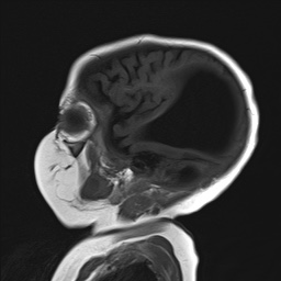 File:Aqueductal stenosis (Radiopaedia 73974-84802 Sagittal T1 4).jpg