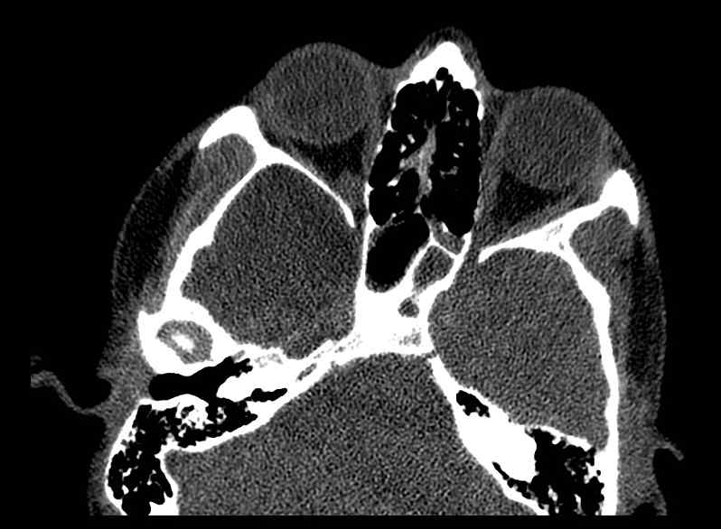 Arachnoid cyst- extremely large (Radiopaedia 68741-78450 Axial bone window 17).jpg