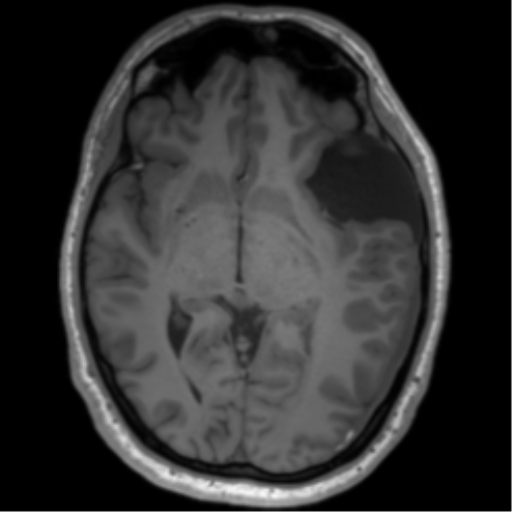 File:Arachnoid cyst with subdural hematoma (Radiopaedia 85892-101743 Axial T1 43).png
