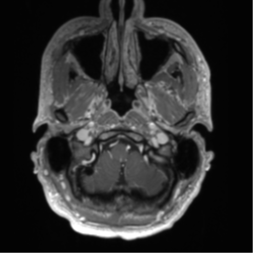 Arachnoid cyst with subdural hematoma (Radiopaedia 85892-101743 Axial T1 C+ 13).png