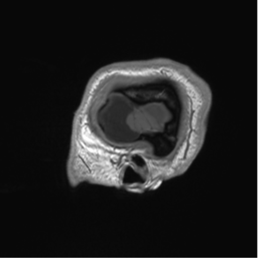 File:Arachnoid cyst with subdural hematoma (Radiopaedia 85892-101743 Sagittal T1 9).png
