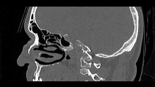 Arcuate foramen (Radiopaedia 89833-106944 Sagittal bone window 34).jpg