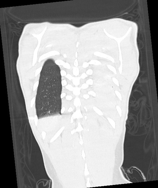 Arrow injury to the chest (Radiopaedia 85367-100975 Coronal lung window 112).jpg
