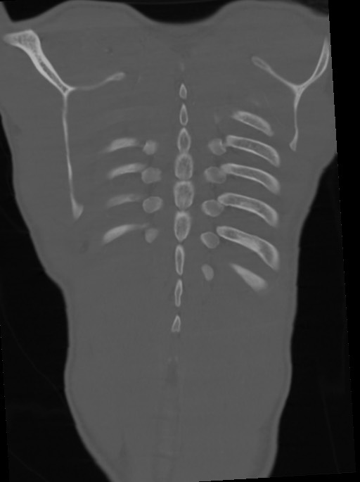Arrow injury to the neck (Radiopaedia 75225-86323 Coronal bone window 105).jpg