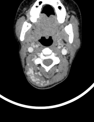 File:Arteriovenous malformation of the neck (Radiopaedia 53935-60062 B 14).jpg