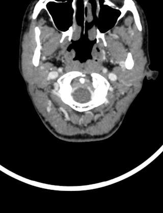 Arteriovenous malformation of the neck (Radiopaedia 53935-60062 B 4).jpg