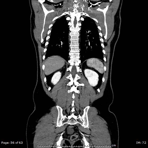 Ascending aortic aneurysm (Radiopaedia 50086-55404 B 56).jpg