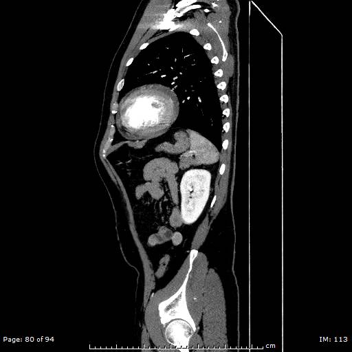 Ascending aortic aneurysm (Radiopaedia 50086-55404 C 57).jpg