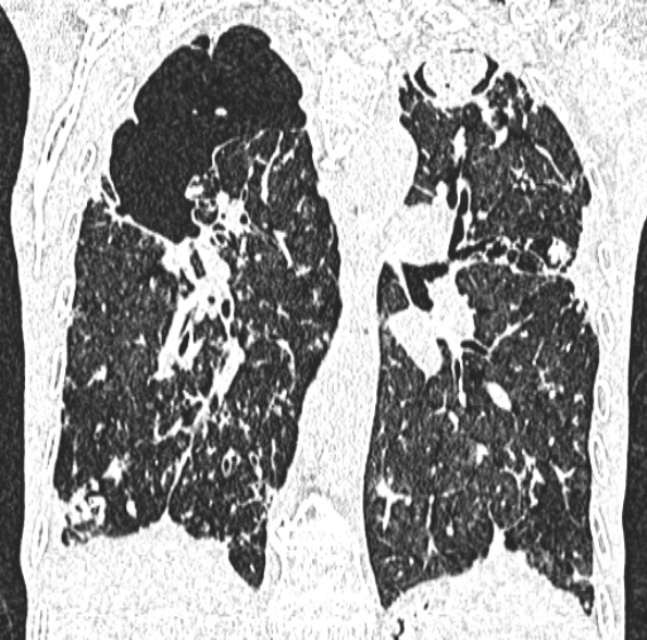 Aspergilloma- with Monod sign (Radiopaedia 44737-48532 Coronal lung window 288).jpg
