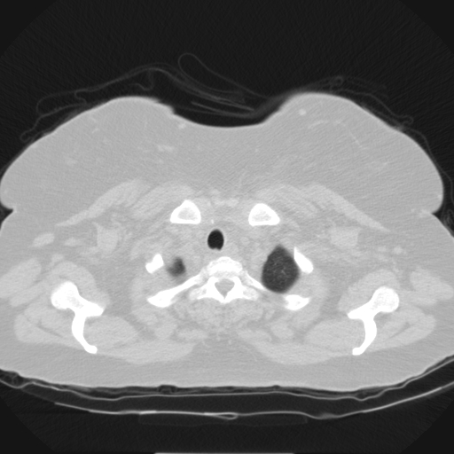 Aspergilloma (Radiopaedia 39611-41932 Axial lung window 2).jpg