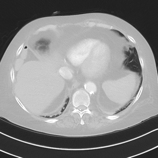 Aspiration bronchiolitis (Radiopaedia 53464-59463 Axial lung window 44).png
