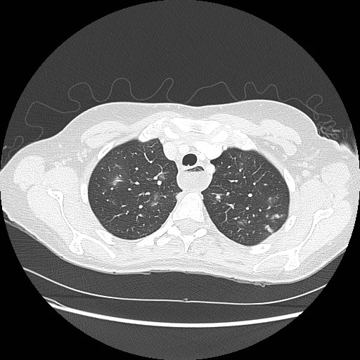 Aspiration pneumonia secondary to laparoscopic banding (Radiopaedia 18345-18183 lung window 20).jpg