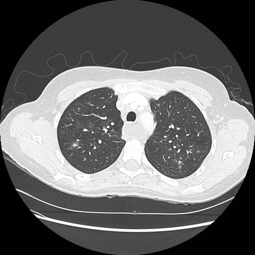 Aspiration pneumonia secondary to laparoscopic banding (Radiopaedia 18345-18183 lung window 26).jpg