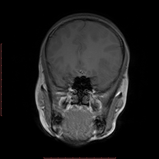File:Astroblastoma (Radiopaedia 74287-85162 Coronal T1 6).jpg