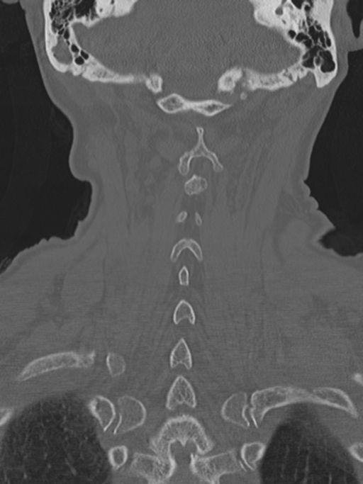 Atlanto-axial subluxation (Radiopaedia 36610-38176 Coronal bone window 39).png