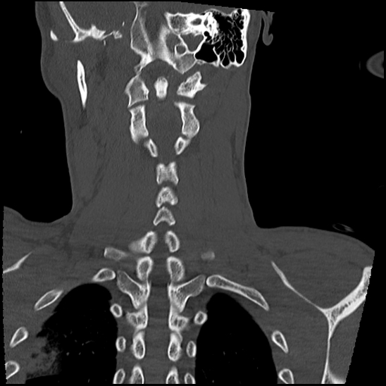 Atlanto-occipital dissociation (Traynelis type 1), C2 teardrop fracture, C6-7 facet joint dislocation (Radiopaedia 87655-104061 Coronal bone window 46).jpg
