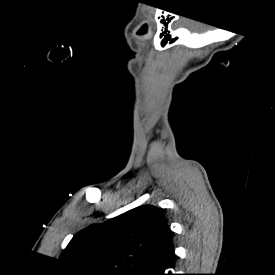 Atlanto-occipital dissociation (Traynelis type 1), C2 teardrop fracture, C6-7 facet joint dislocation (Radiopaedia 87655-104061 D 75).jpg