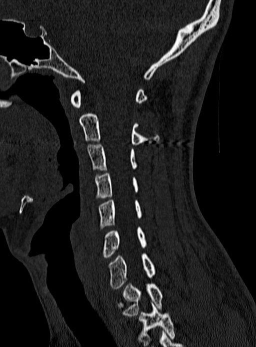 Atlantoaxial subluxation (Radiopaedia 44681-48450 Sagittal bone window 52).jpg