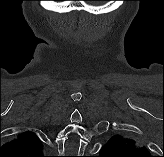 Atlas (type 3b subtype 1) and axis (Anderson and D'Alonzo type 3, Roy-Camille type 2) fractures (Radiopaedia 88043-104607 Coronal bone window 57).jpg
