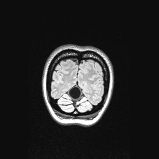File:Atretic encephalocoele with inferior vermis hypoplasia (Radiopaedia 30443-31108 Coronal FLAIR 28).jpg
