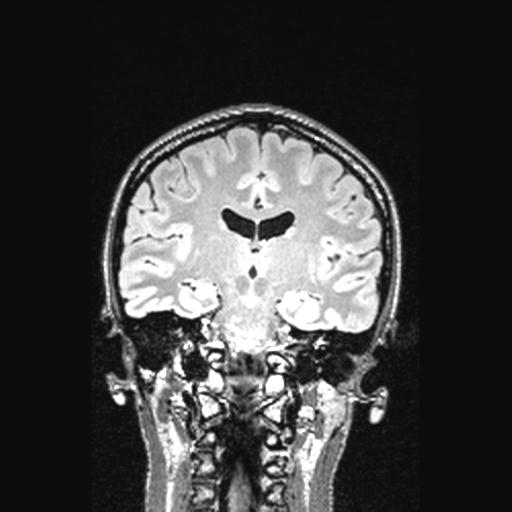 Atretic encephalocoele with inferior vermis hypoplasia (Radiopaedia 30443-31108 Coronal FLAIR 88).jpg