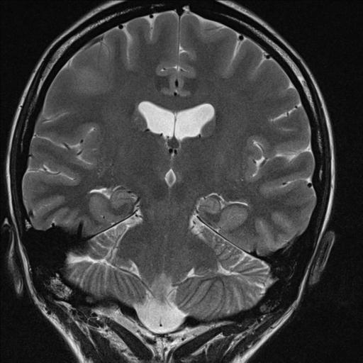 File:Atretic encephalocoele with inferior vermis hypoplasia (Radiopaedia 30443-31108 Coronal T2 4).jpg