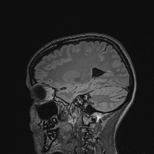 Atretic encephalocoele with inferior vermis hypoplasia (Radiopaedia 30443-31108 Sagittal FLAIR 106).jpg